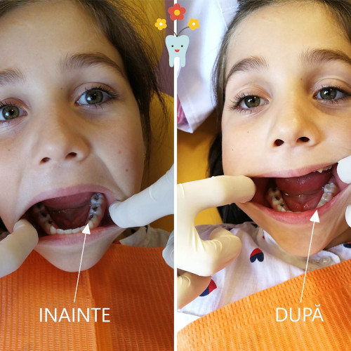 Zâna Merciluță - Înainte după plombare carie